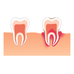 Gum Treatment—Pngtree—tooth inflammation periodontitis_6692685