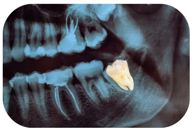 The Wisdom Teeth Removal Process: What to Expect | DentalEazy